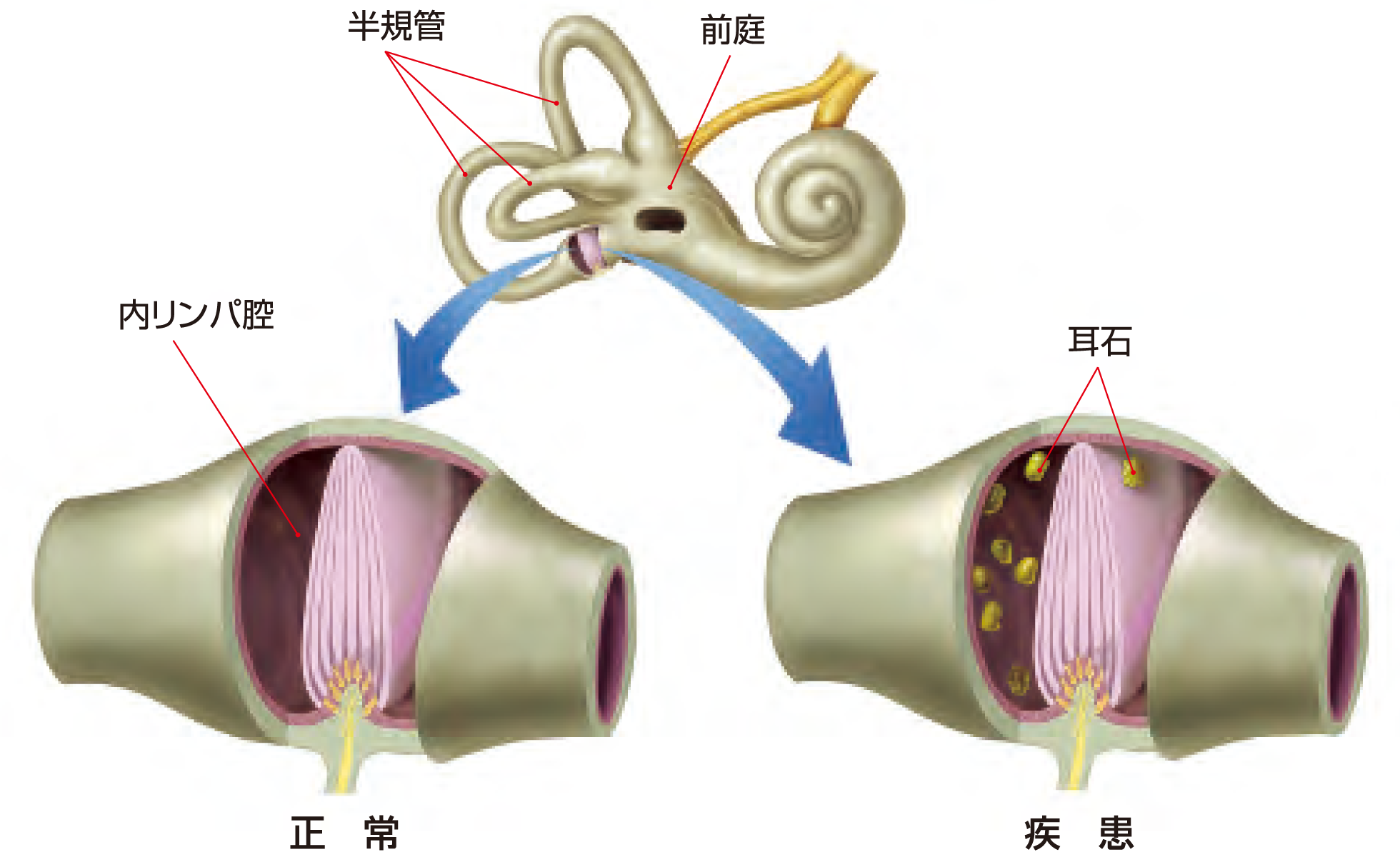 内耳の中の浮遊物